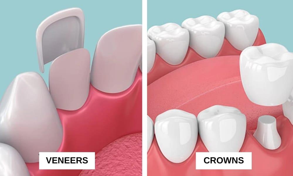 Decoding the Difference: Dental Crowns vs. Veneers and When to Choose Each