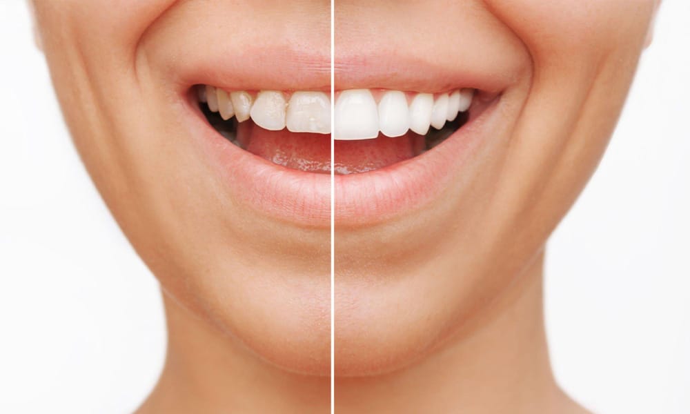 Say Goodbye to Imperfections: How Dental Veneers Can Correct Common Dental Issues