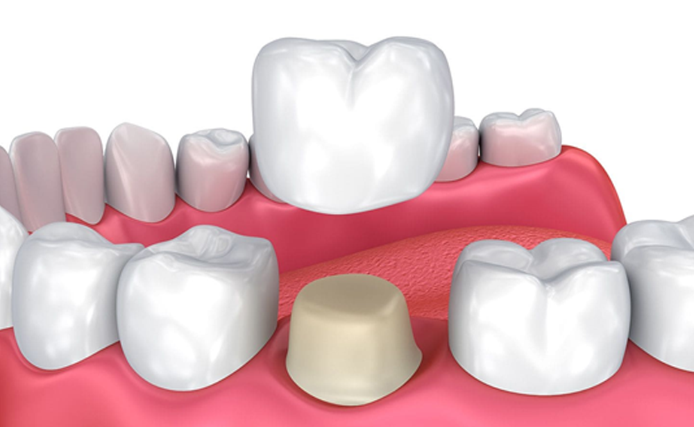 When Are Dental Crowns Necessary? Signs That You May Need Them