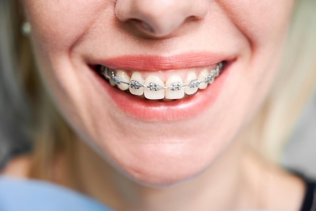 Braces and Diet: Foods to Avoid and Foods That Are Safe