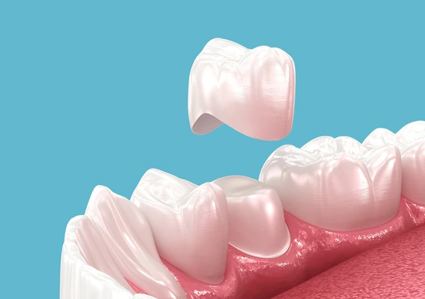 Why Dental Crowns Are a Game-Changer for Tooth Restoration